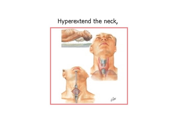 Hyperextend the neck, 