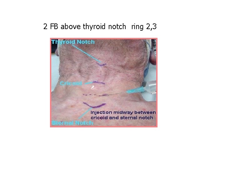 2 FB above thyroid notch ring 2, 3 