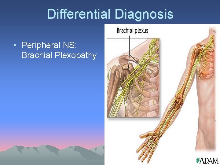 Differential Diagnosis • Peripheral NS: Brachial Plexopathy 