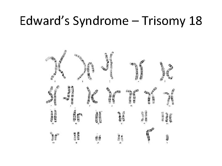 Edward’s Syndrome – Trisomy 18 