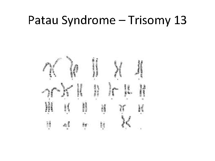 Patau Syndrome – Trisomy 13 