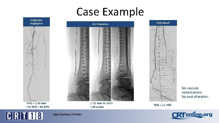 Diagnostic Angiogram Case Example IVL Procedure Final Result No vascular complications No post dilatation