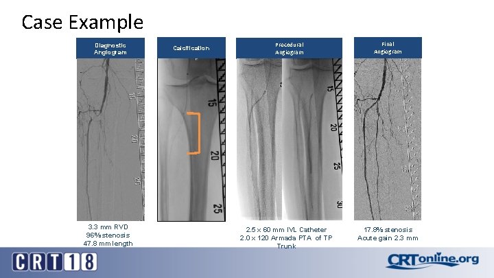 Case Example Diagnostic Angiogram 3. 3 mm RVD 96% stenosis 47. 8 mm length