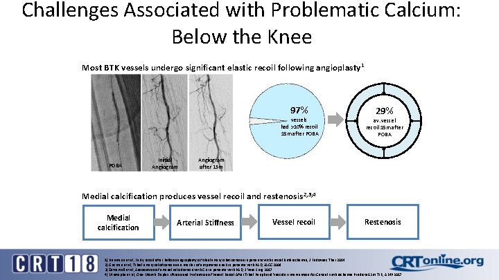 Challenges Associated with Problematic Calcium: Below the Knee Most BTK vessels undergo significant elastic