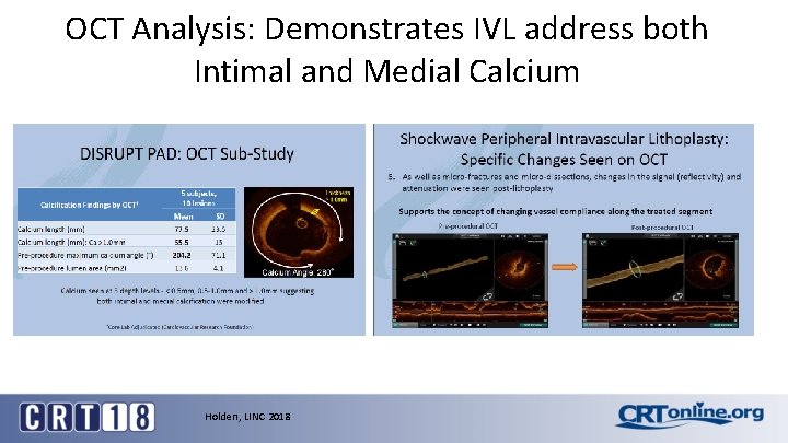 OCT Analysis: Demonstrates IVL address both Intimal and Medial Calcium Holden, LINC 2018 