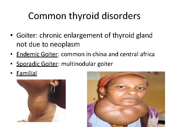Common thyroid disorders • Goiter: chronic enlargement of thyroid gland not due to neoplasm