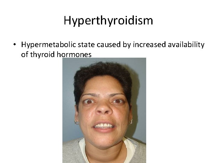 Hyperthyroidism • Hypermetabolic state caused by increased availability of thyroid hormones 