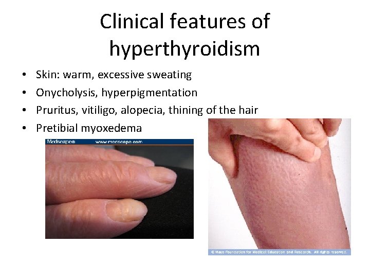 Clinical features of hyperthyroidism • • Skin: warm, excessive sweating Onycholysis, hyperpigmentation Pruritus, vitiligo,