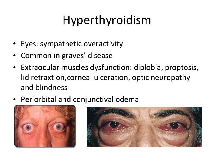 Hyperthyroidism • Eyes: sympathetic overactivity • Common in graves’ disease • Extraocular muscles dysfunction: