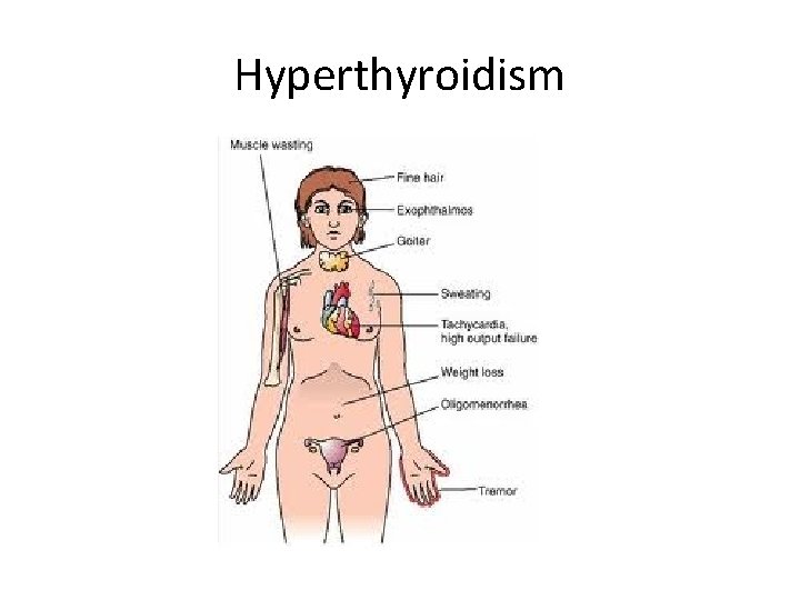 Hyperthyroidism 