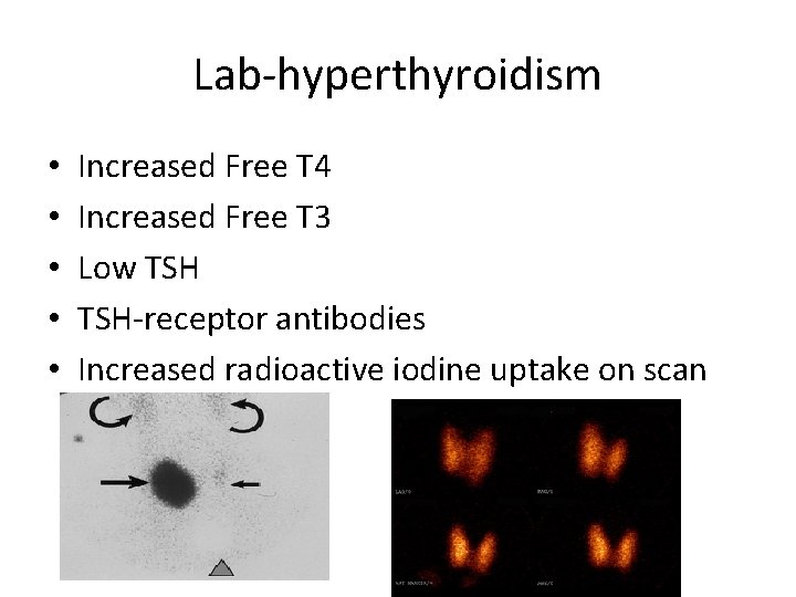 Lab-hyperthyroidism • • • Increased Free T 4 Increased Free T 3 Low TSH-receptor