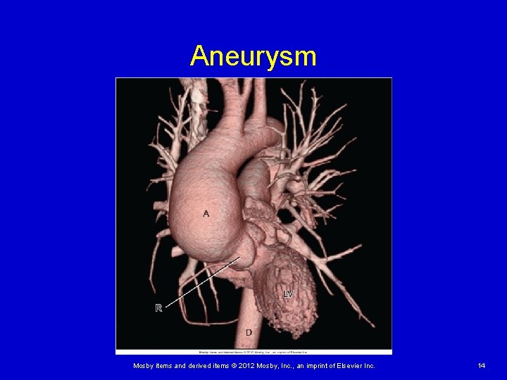 Aneurysm Mosby items and derived items © 2012 Mosby, Inc. , an imprint of