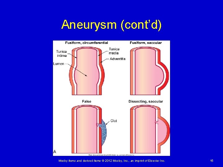 Aneurysm (cont’d) Mosby items and derived items © 2012 Mosby, Inc. , an imprint