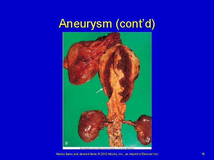 Aneurysm (cont’d) Mosby items and derived items © 2012 Mosby, Inc. , an imprint