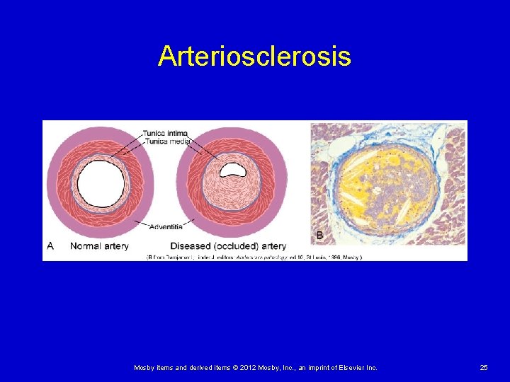 Arteriosclerosis Mosby items and derived items © 2012 Mosby, Inc. , an imprint of