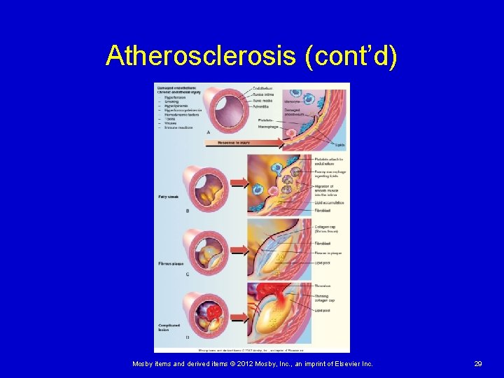 Atherosclerosis (cont’d) Mosby items and derived items © 2012 Mosby, Inc. , an imprint