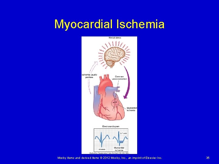 Myocardial Ischemia Mosby items and derived items © 2012 Mosby, Inc. , an imprint