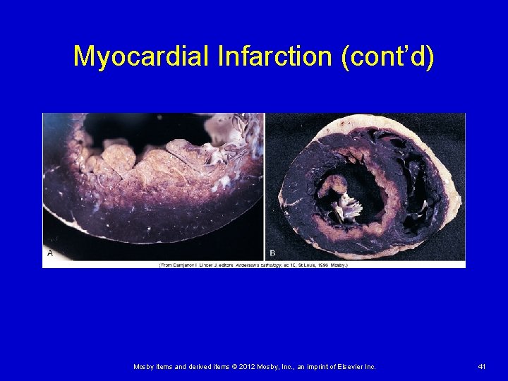 Myocardial Infarction (cont’d) Mosby items and derived items © 2012 Mosby, Inc. , an