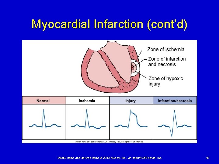 Myocardial Infarction (cont’d) Mosby items and derived items © 2012 Mosby, Inc. , an