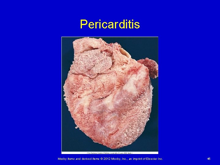 Pericarditis Mosby items and derived items © 2012 Mosby, Inc. , an imprint of