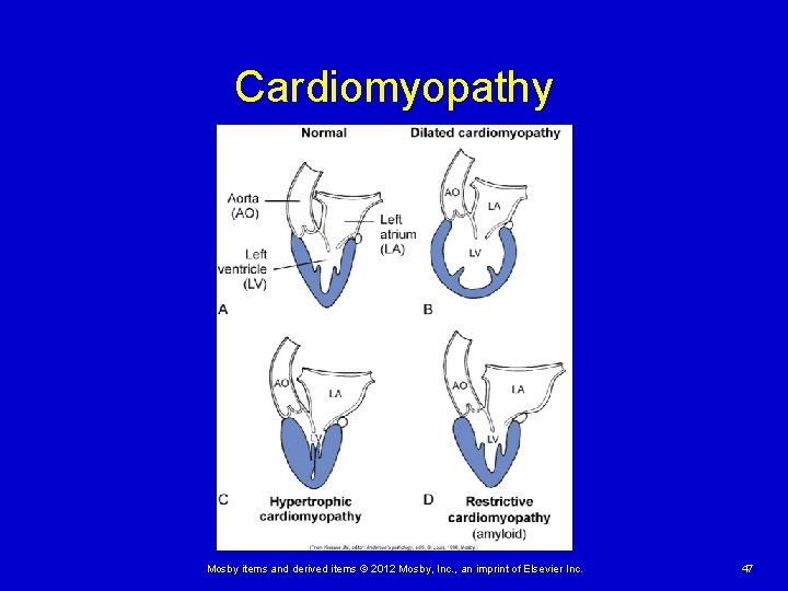 Cardiomyopathy Mosby items and derived items © 2012 Mosby, Inc. , an imprint of