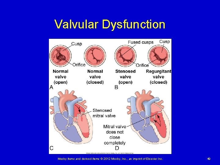 Valvular Dysfunction Mosby items and derived items © 2012 Mosby, Inc. , an imprint