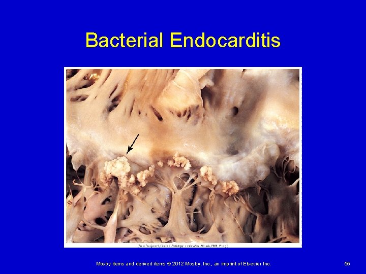 Bacterial Endocarditis Mosby items and derived items © 2012 Mosby, Inc. , an imprint