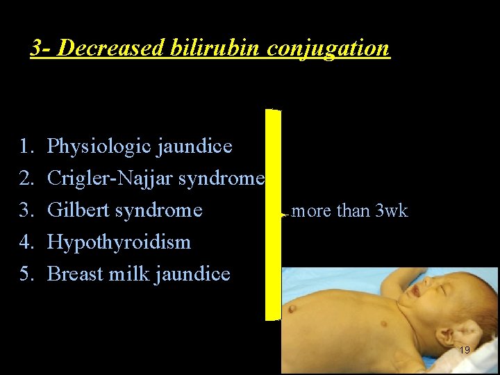 3 - Decreased bilirubin conjugation 1. 2. 3. 4. 5. Physiologic jaundice Crigler-Najjar syndrome