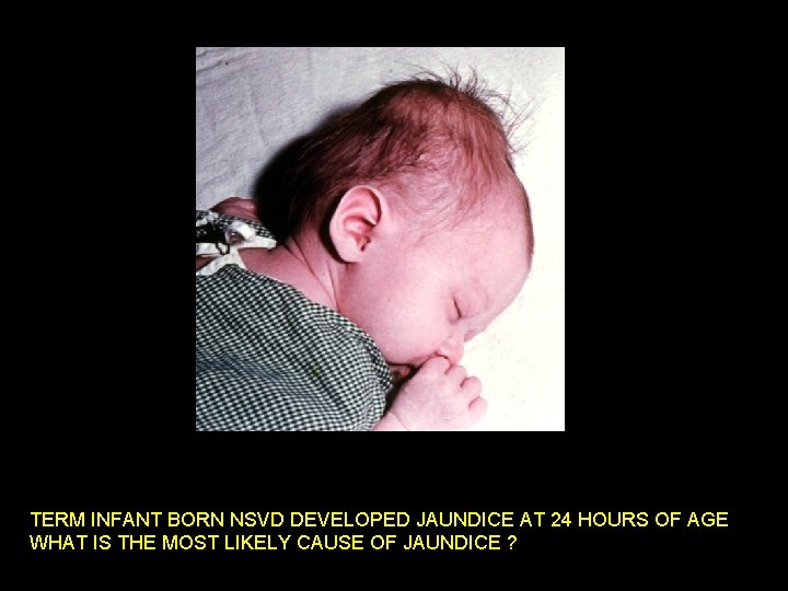 TERM INFANT BORN NSVD DEVELOPED JAUNDICE AT 24 HOURS OF AGE WHAT ISJune THE