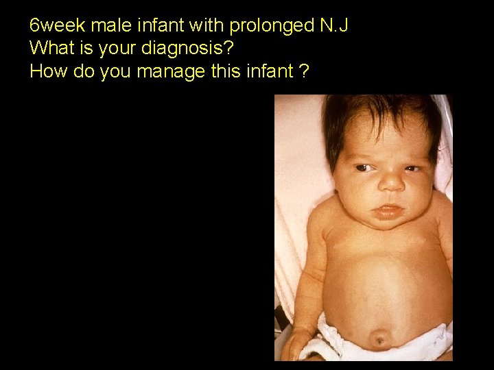 6 week male infant with prolonged N. J What is your diagnosis? How do