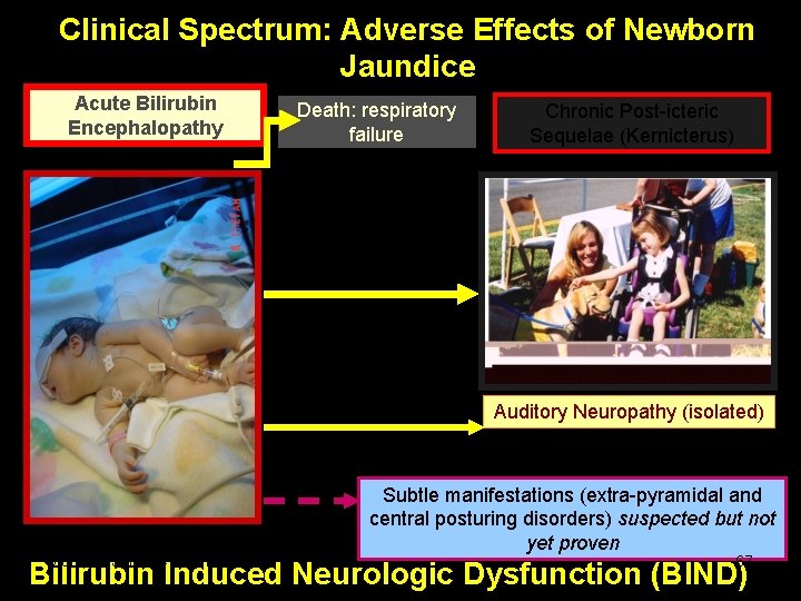 Clinical Spectrum: Adverse Effects of Newborn Jaundice Acute Bilirubin Encephalopathy Death: respiratory failure Chronic