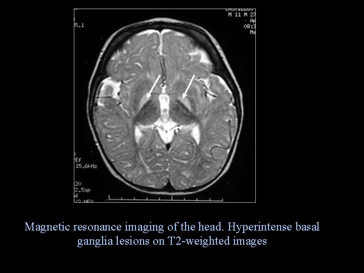 Magnetic resonance imaging of the head. Hyperintense basal ganglia lesions on T 2 -weighted
