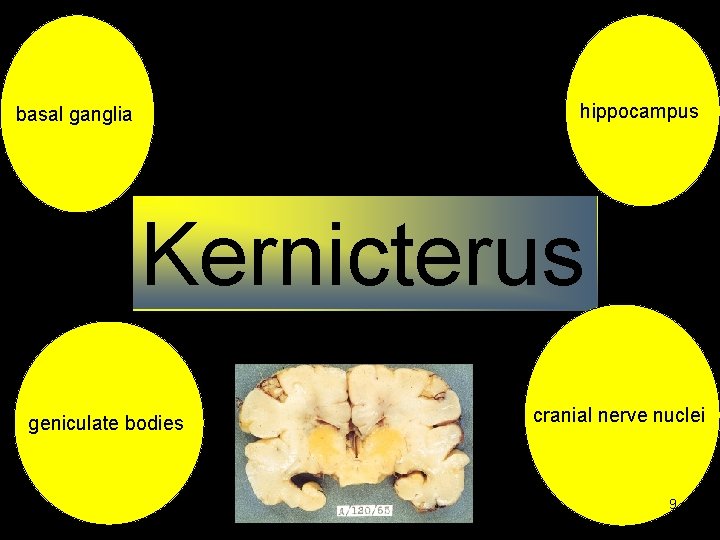 hippocampus basal ganglia Kernicterus geniculate bodies cranial nerve nuclei 9 