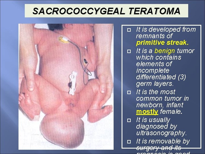 SACROCOCCYGEAL TERATOMA It is developed from remnants of primitive streak. It is a benign