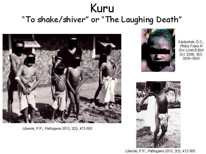 Kuru “To shake/shiver” or “The Laughing Death” Gajdushek, D. C. , Philos Trans R