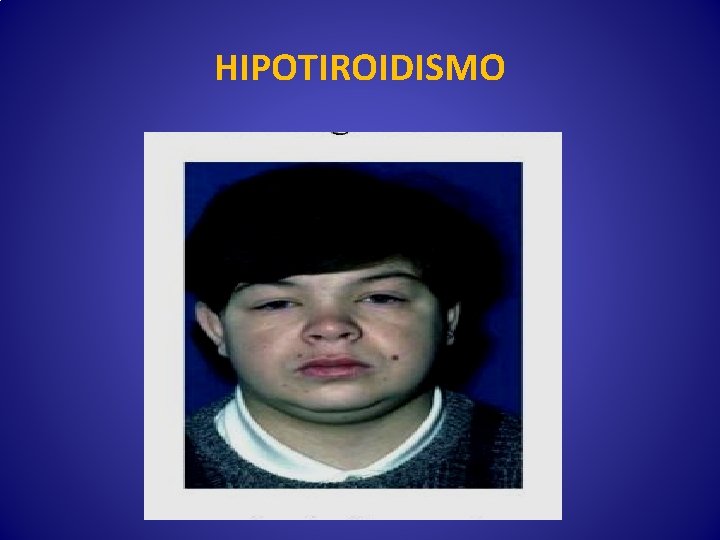 HIPOTIROIDISMO 