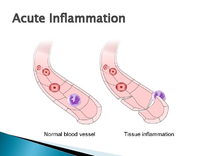 Acute Inflammation 