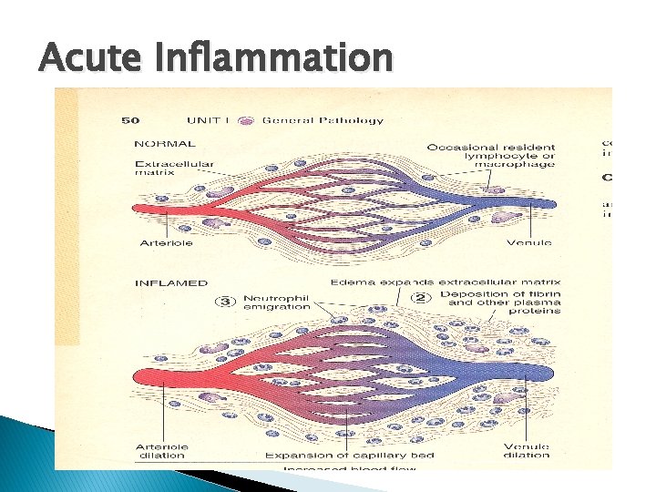Acute Inflammation 
