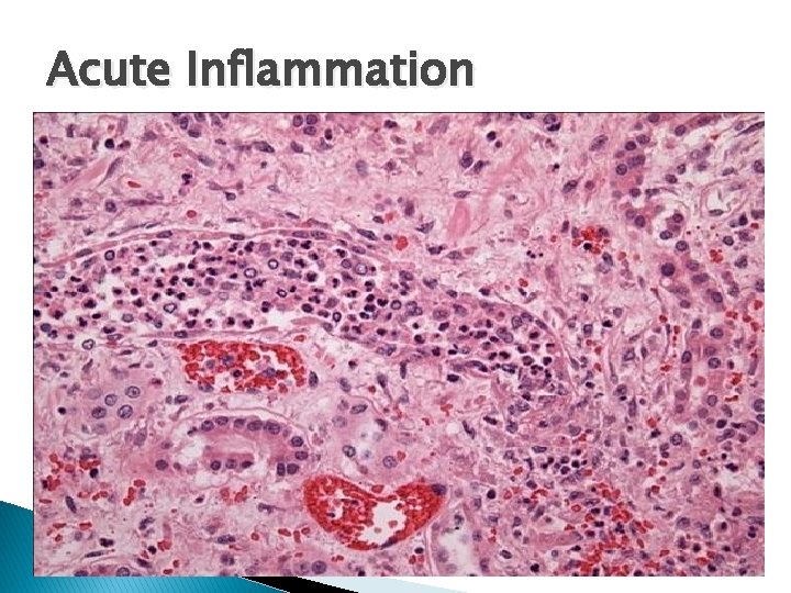 Acute Inflammation 