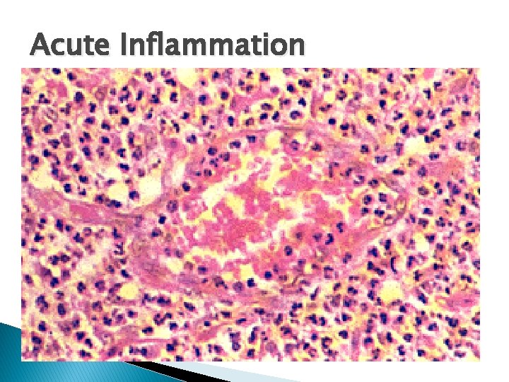 Acute Inflammation 
