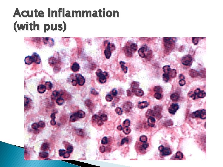 Acute Inflammation (with pus) 