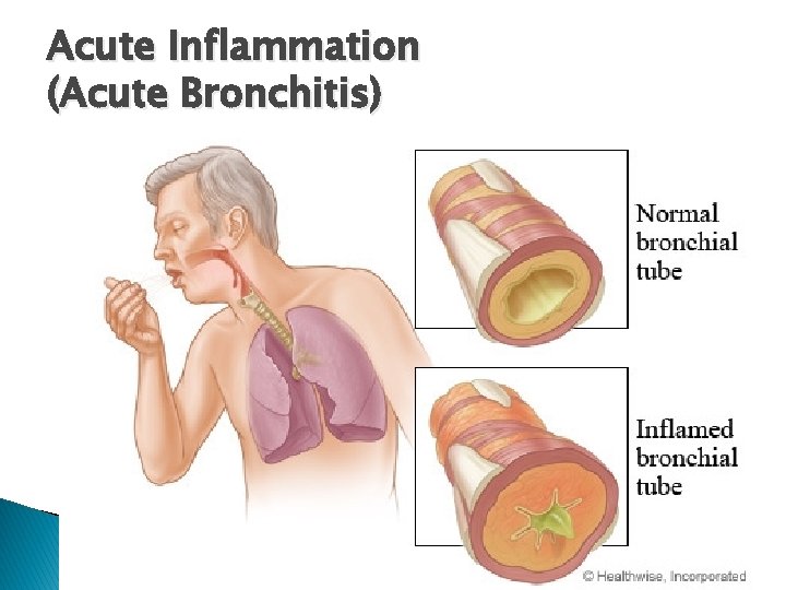 Acute Inflammation (Acute Bronchitis) 