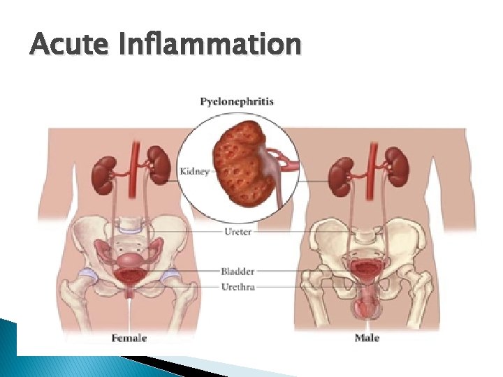 Acute Inflammation 
