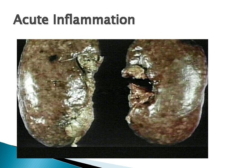 Acute Inflammation 