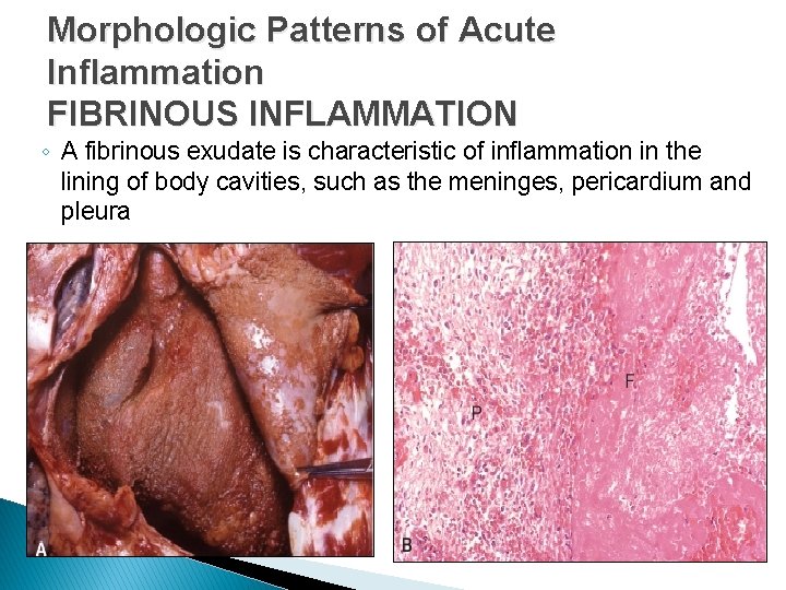 Morphologic Patterns of Acute Inflammation FIBRINOUS INFLAMMATION ◦ A fibrinous exudate is characteristic of