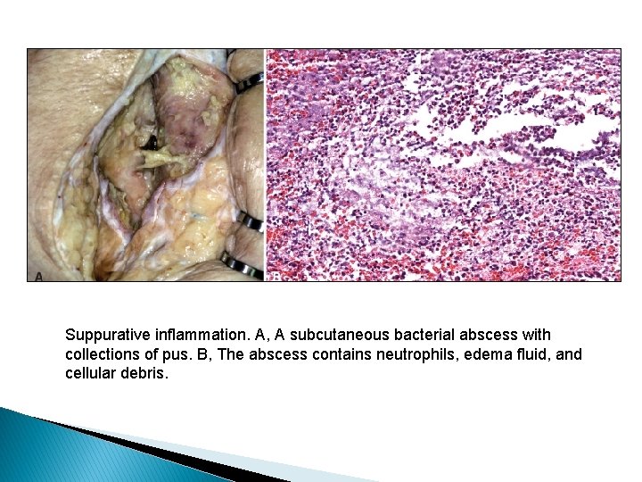 Suppurative inflammation. A, A subcutaneous bacterial abscess with collections of pus. B, The abscess