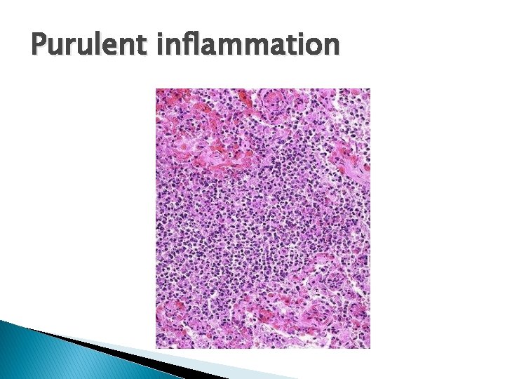 Purulent inflammation 