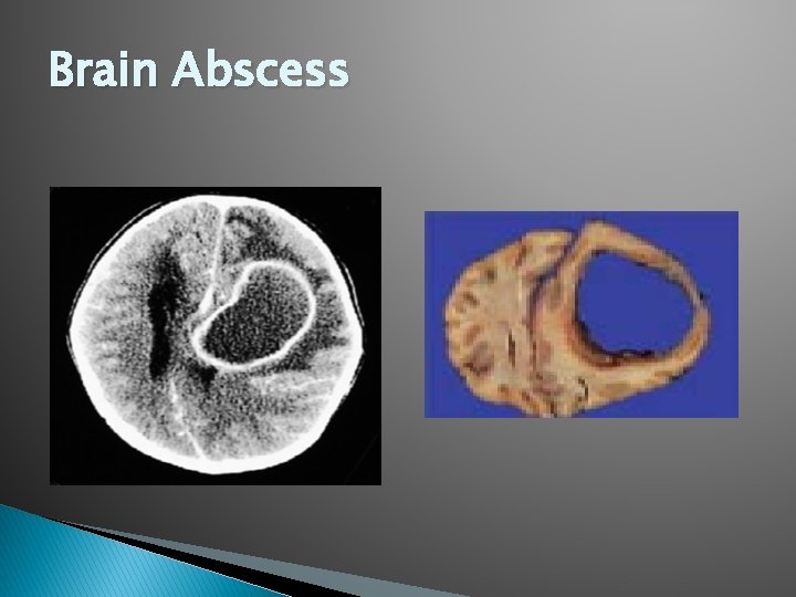 Brain Abscess 