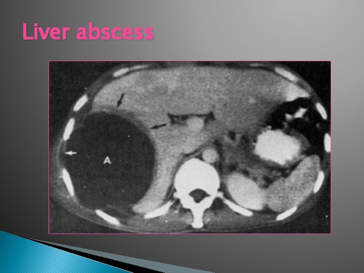 Liver abscess 