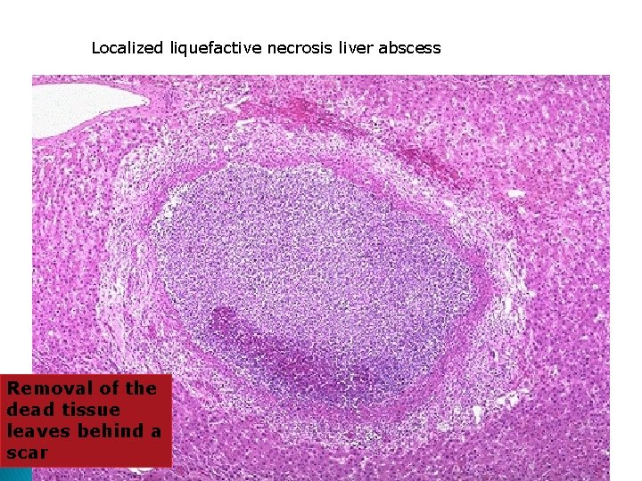 Localized liquefactive necrosis liver abscess Removal of the dead tissue leaves behind a scar